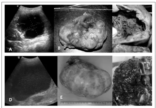 Figura  1  -  (A)  e  (D)  Imagens  ultrassonográficas  em  plano  sagital  dos  casos  4  e  5,  nas  quais  observa- observa-se    perda  da  arquitetura  interna  renal,  visualizada  nos  casos  de  adenocarcinoma