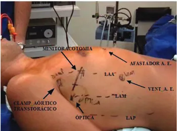 Fig. 1 – Patient positioning and the site marks for minithoracotomy incision, transthoracic aortic clamping, trocars for optical device, left atrial aspirator, and left atrial retractor