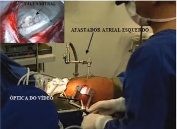 Fig. 2 – Operative Field aspect, showing the left atrial retractor, minithoracotomy, and the site of the optical vídeo system