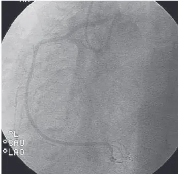 Fig. 1 - Cineangiocoronariografia da CD