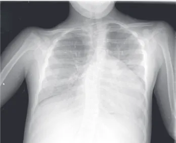 Fig. 2 – Chest roentgenography showing the increase of cardiac area and pulmonary hyperflow signs