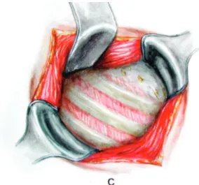 Fig. 3 – Auscultatory triangle – the muscles are drawn and the ribs are exposed