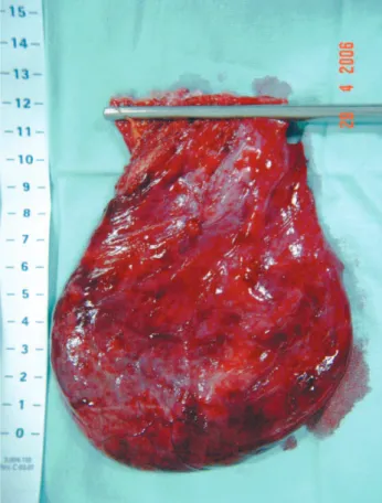 Fig. 2 – Macroscopic appearance of a giant pericardial cyst