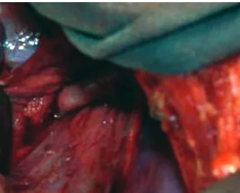 Fig. 4 – Side-to-End Anastomosis between left carotid artery and left subclavian artery