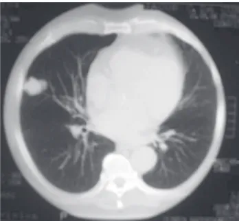 Fig. 2 – Benign tumor tomography imaging of inferior lobe of right lung