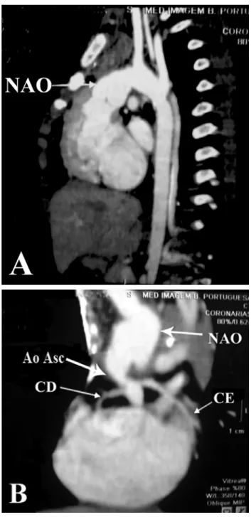 Fig. 4 – Tomography angiography: A: Neoaorta with good anatomic result 2 years after surgery and B: Aspect of coronary arteries and native aorta anastomosed to the neoaorta