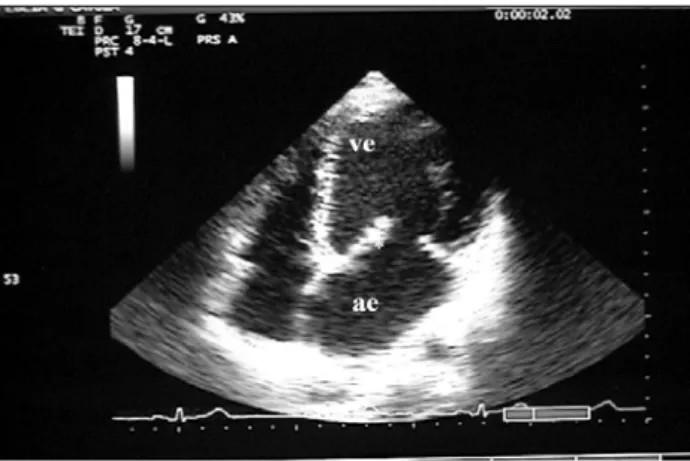 Fig. 2 – The same view with color-flow mapping showing a significant mitral valve regurgitation jet with the Coanda effect (arrow), regurgitant volume of 260 mL and vena contracta of 1.1 cm originating from the rupture site (asterisk)