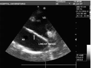 Fig. 1 – Echocardiogram showing dense intra-atrial linear image