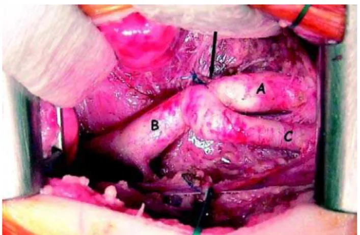 Fig. 2 – Aspecto inicial após dissecção das estruturas e ligadura do canal arterial. A região da coarctação é indicada pela seta, A:
