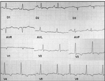 Fig. 1 – Electrocardiograph trace showing diffuse repolarization alterations with T-wave inversion