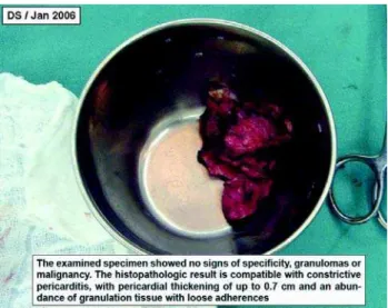 Fig. 4 – Comparative image showing patient before and 21 days after the operation to remove the pericardium: there was a great weight loss (around 70 kg) which was due to water retention