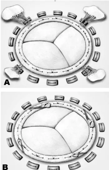 Fig. 2 –A: Implanted bioprosthesis with papillary traction. B: