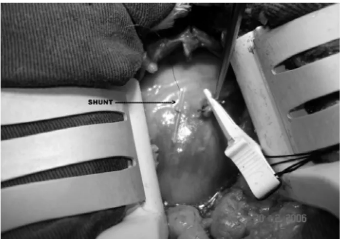 Fig. 1 – Retractor for the dissection of the LITA by minithoracotomy