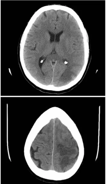 Fig. 1 and 2 - CT scans showing left parieto-occipital hypodensity with surrounding white matter edema suggestive of hyperperfusion injury