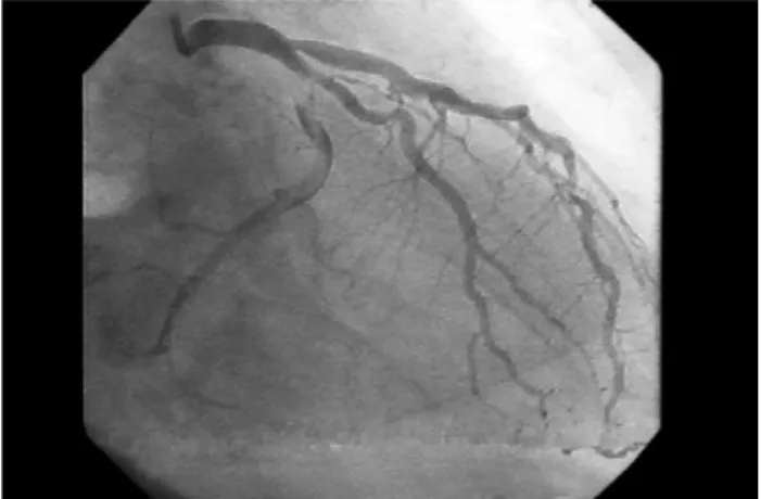 Fig. 1 – Dissection in the circumflex coronary artery as seen by coronary angiography