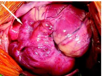 Fig. 2 – left atrial isomerism (arrow)