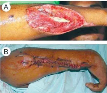 Fig. 1 – A:  Elliptical wound; B: Edges reconstruction using metal shafts