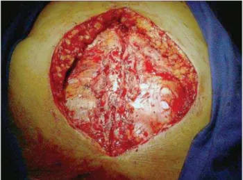 Fig. 2 – Chest wall defect