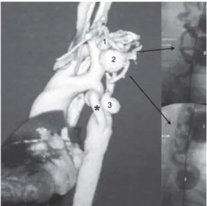 Fig. 2 - Postoperative chest computed tomography with three- three-dimensional reconstruction, showing patent ascending aorta to descending aorta extra-anatomic bypass (§), the previous obstructed graft (*) and involution of all aneurysms