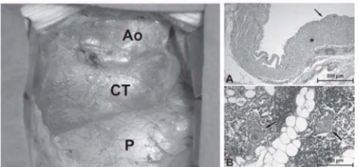 Fig. 1 Thoracic aorta angiotomography – CT chest image in sagittal position (at left) and in axial position (at right) showing cystic formation encircling the ascending aorta.