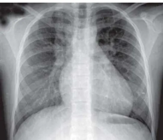 Fig. 2 – Chest radiography without significant changes indicating interatrial communication