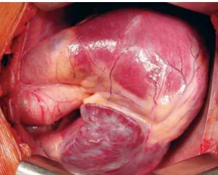 Fig. 5 – Opened right atrium with ostium secundum-type interatrial communication corrected with bovine pericardium patch