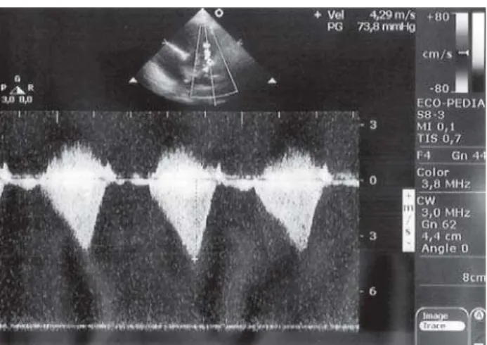 Fig. 1 – Continuous Doppler for pulmonary flow analysis obtained through parasternal short axis view showing infundibular systolic peak of 73.8 mmHg