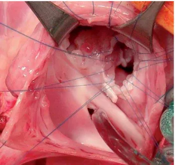 Fig. 1 – Opened right atrium, where it can be observed interventricular communication with polypropylene stitches around the orifice prior to the closure with the bovine pericardial patch