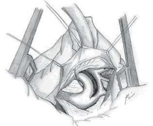 Fig. 6 – Wide resection of the coarctation area and the hypoplastic aortic arch