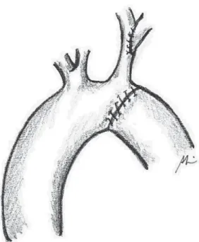Fig. 9 – Control Echo-Doppler in operated patient, showing aortic arch after surgical correction without residual stenosis