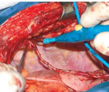 Fig. 1 - Skeletonized Internal Thoracic Artery