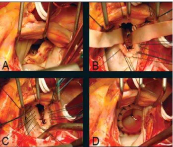 Fig. 2 (A) Severe mitral valve calcification, (B) crossed BP strips fixed to the edge of papillary muscles; (C) Suturing of BP strips on the mitral annulus; (D) Implanted mitral bioprosthesis