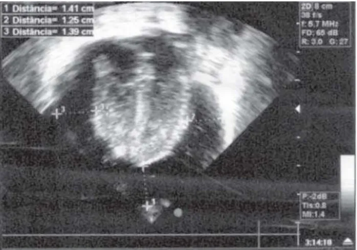 Fig. 1 – Echocardiogram of Case 1 showing severe pericardial effusion