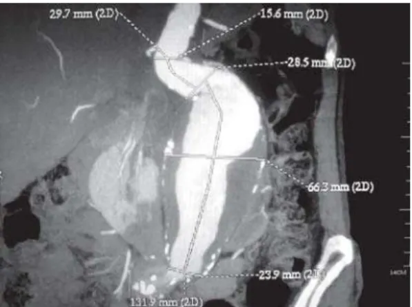 Fig. 1 - Computed tomography showing an abdominal aortic aneurysm (AAA) and horseshoe kidney