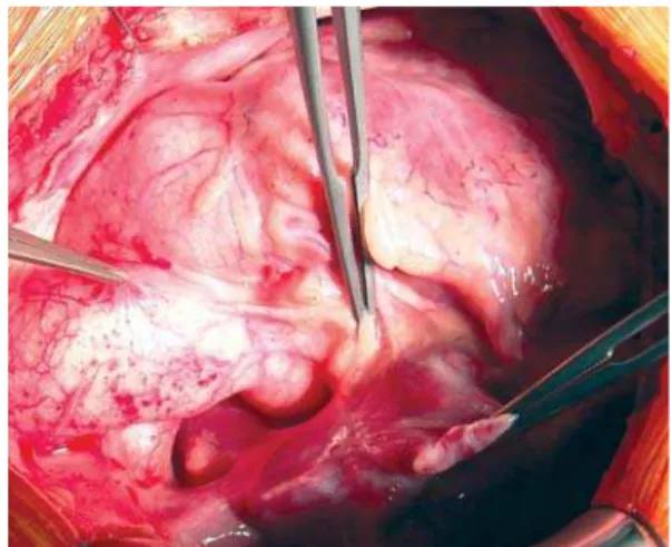 Fig. 2 – External view of the location of the narrowing of the ascending aorta