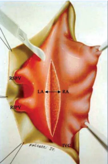 Fig. 1 – Interatrial sulcus opening