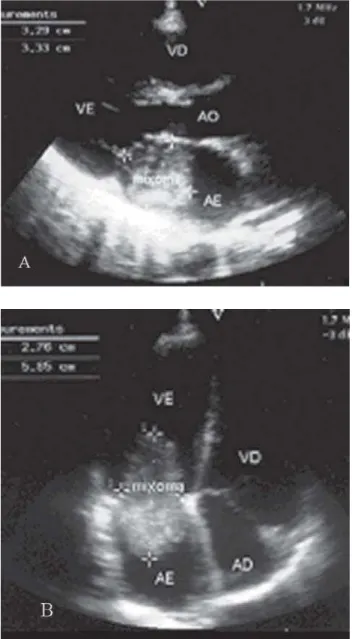 Fig. 1 - Transthoracic echocardiogram. A – Preoperative. B – Atrial tumor prolapse through the mitral valve toward the left ventricle during ventricular diastole