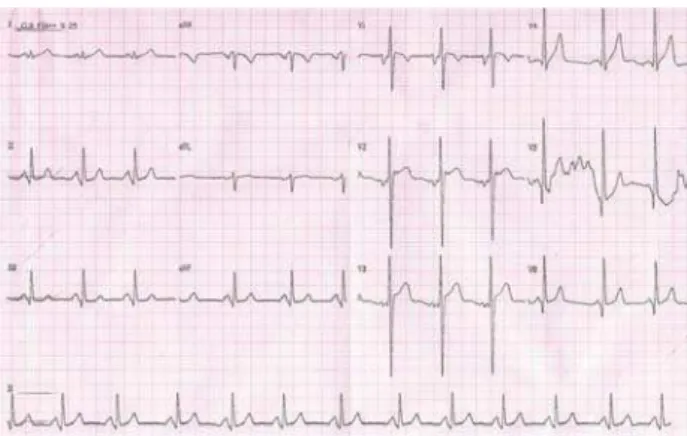 Fig. 1 – Eletrocardiograma em doença valvar mitral com sobrecarga de câmaras esquerdas