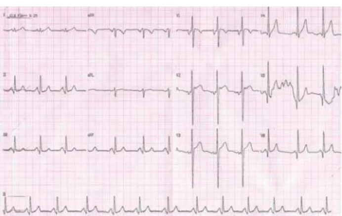 Fig. 1 – Electrocardiogram showing mitral valve disease with left chamber overload