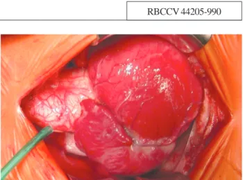 Fig. 1 – Torniquete para cadarçamento da artéria pulmonar direita imediatamente após abertura do saco pericárdico