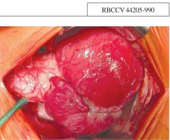 Fig. 1 – Tourniquet for ligation of the right pulmonary artery immediately after opening the pericardium flap.Important maneuver for better surgical outcome