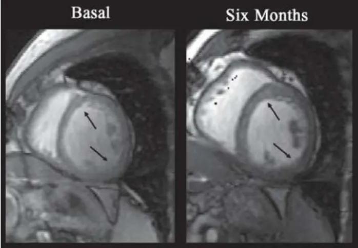 Fig. 4 – Images obtained by CMR from the short axis of LV. The arrows indicate myocardial segments with clear increase of contractility