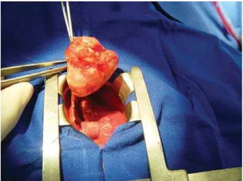 Fig. 3 – Tumoral mass after resection