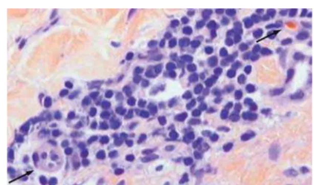 Fig. 2 – Histopathologic study of the aorta tunica media. Aorta tunica media with inflammatory infiltrate with plasmocytes (right superior Arrow) and lymphocytes with arteriole with endothelial reactivity (left inferior arrow).[Hematoxylin &amp; Eosin, x40