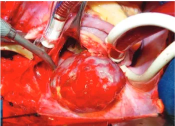 Fig. 1 – Intraoperatory aspect of neoplasia after atrial opening