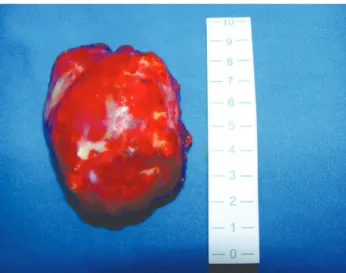 Fig. 2 – Aspect and measurement of neoplasia after complete resection