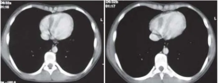 Fig. 1 – Tomografia computadorizada do tórax após contraste endovenoso – Imagem hipodensa em topografia do átrio direito