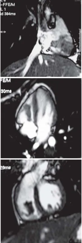 Fig. 3 – Neoplasia mesenquimal de baixo grau com estroma de aspecto mixóide e células fusiformes sem atipias