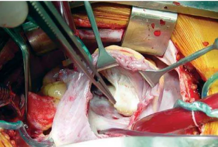 Fig. 4 – Aspecto intra-operatório do tumor aderido ao ventrículo direito e totalmente à cúspide posterior da valva tricúspide