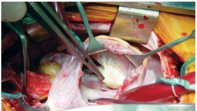 Fig. 4 – Intraoperative aspect of the tumor adherent to the right ventricle and totally adherent to the posterior cuspid of tricuspid valve